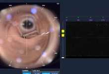 Operație de cataractă cu viziune de recuperare cu laser laser
