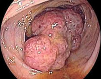 Tumorile intestinului gros - cauze, simptome, diagnostic și tratament