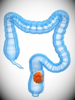 Tumorile intestinale prezintă primele semne și simptome, diagnostic și prognostic