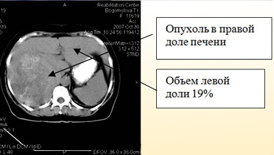 Tulburările hepatice determină simptomele și tratamentul