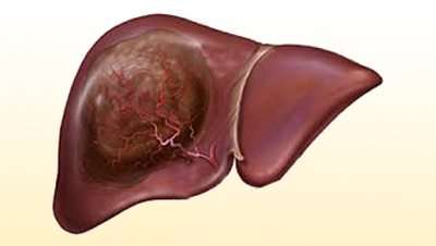 Tulburările hepatice determină simptomele și tratamentul