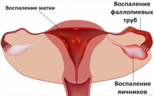 Tumorile ovarelor la femei simptome, cauze, tratament