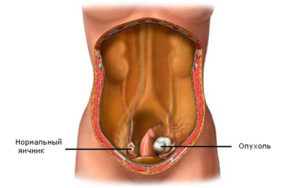 Tumorile ovarelor la femei simptome, cauze, tratament