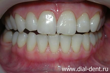 Albirea dinților înainte de restaurarea estetică