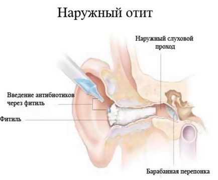 Tratamentul otitei, cauzele, diagnosticul bolii, recomandări