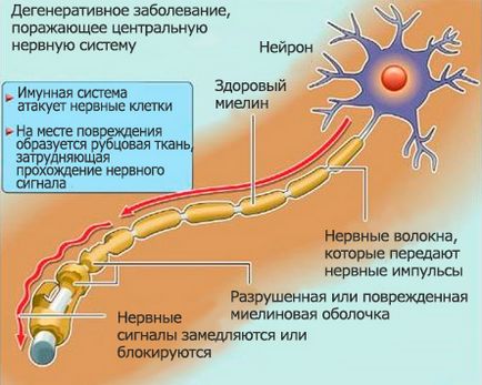 Descoperirea secolului 21 - bolile neurologice și psihice sunt vindecabile în ehmm!