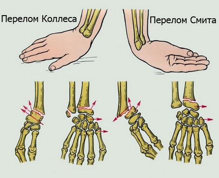 Fractura de raza a brațului cât de mult să poarte gips, tratament, perioada de aderență