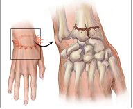 Personal site - egy törés a distalis radius metaepiphysis (törés a radiális csont egy tipikus