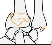 Personal site - egy törés a distalis radius metaepiphysis (törés a radiális csont egy tipikus