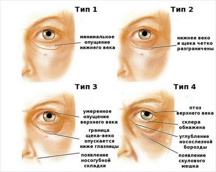 Чому у людей бувають опущені повіки, як їх підняти без операції