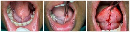 Підрізання вуздечки - стоматологія; підрізати вуздечку язика і верхньої губи в москві