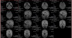 Vor apărea nervi, metastaze, microinsult, meningită, ulcere