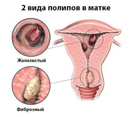 Polipii din uter sunt ceea ce, specii decât cele periculoase, diagnosticul și tratamentul