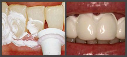 Tratamentul cariilor dentare cervicale, simptome, etape și prevenire