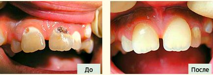 Tratamentul cariilor dentare cervicale, simptome, etape și prevenire