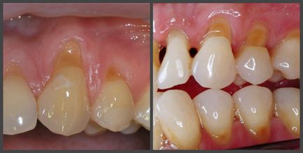 Tratamentul cariilor dentare cervicale, simptome, etape și prevenire