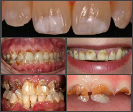 Пришийковий карієс зубів лікування, симптоми, стадії і профілактика