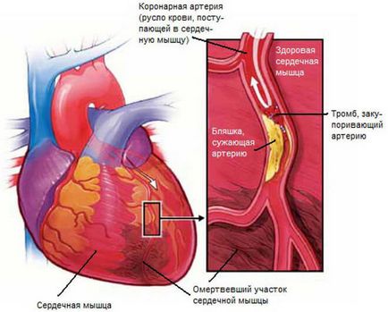Profilaxia unui cheag de sânge în inimă