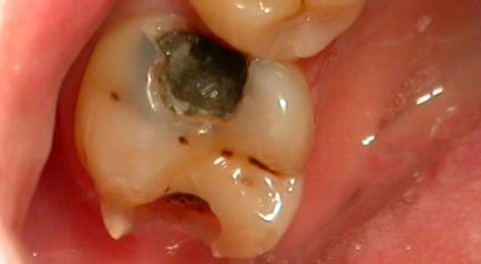 Dentare dinte - motive și simpozioane