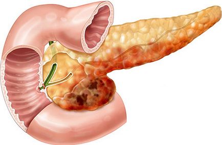Reaktív pancreatitis, mi ez, tünetek és kezelések, amelyek lehet enni növekvő farok