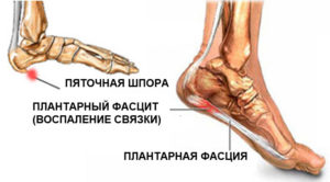 Spurs pe tocuri de cauză, simptome, tratament și prevenire