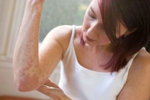 Simptomele și semnele de dermatită la adulți pe brațe, picioare, fotografii