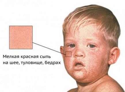 Висип при скарлатині у дітей характер і форми захворювання