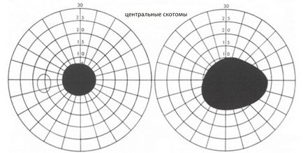 Scotoma szemek - okai, tünetei és kezelése