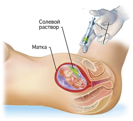 Avortul cu săruri
