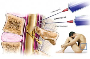 Spondilitatea și consecințele anesteziei spinale