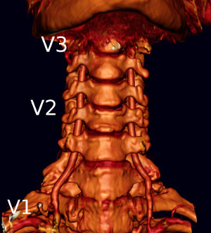 Stenoza arterei vertebrale