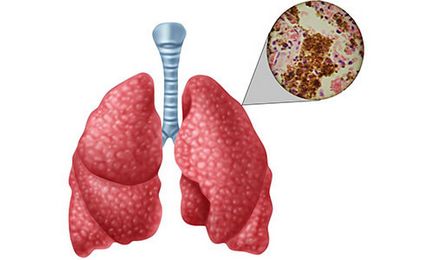 Зв'язок, діагностика і лікування туберкульозу легенів і цукрового діабету