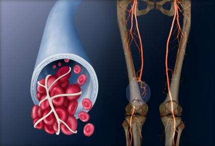 Tromboflebita și operația pe care trebuie să o cunoașteți, uflebologa