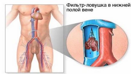 Tromboflebita și operația pe care trebuie să o cunoașteți, uflebologa