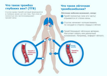 Tromboflebita și operația pe care trebuie să o cunoașteți, uflebologa