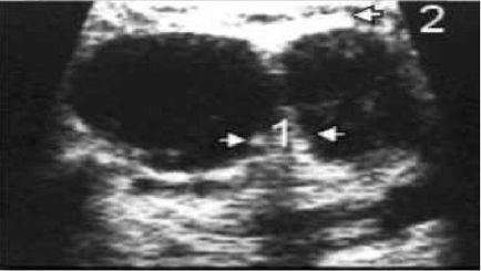 Examinarea ultrasonică a ganglionilor limfatici