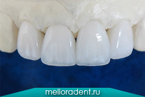 Установка цирконієвих коронок в стоматології в москві, ціни