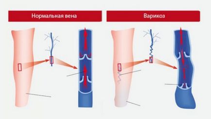 Варіфорт від компанії здоровий відгуки про лікування микросферами, лікування варикозу ніг і судин