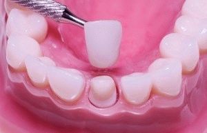 Tipuri de coroane dentare