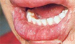 Хейліт захворювання губ симптоми; хейліт на губах фото; хейліт губ причини, лікування і профілактика