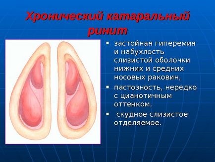 Simptomele rinitei catarale cronice și tratamentul la domiciliu