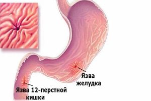 Запори після відмови від куріння причини і що робити