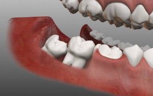 Dinți dinți Simptome de erecție și inflamație