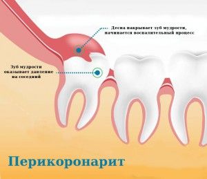 Dinți dinți Simptome de erecție și inflamație