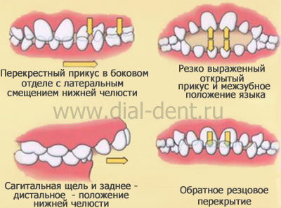 Anomaliile dentofacial în timpul mușcăturii