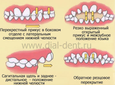 Зубощелепні аномалії в період молочного прикусу