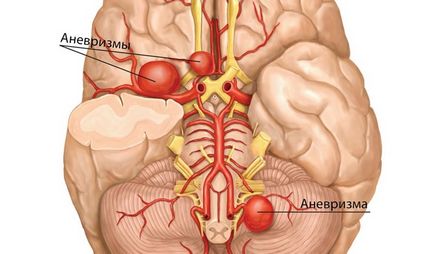 Anevrismul vaselor cerebrale