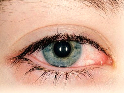 Angioscleroza retinei ce este?