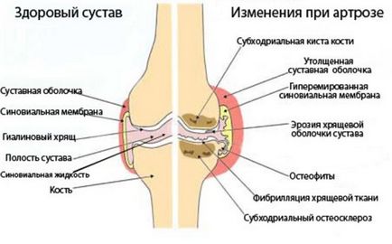 Артроз колінного суглоба лікування народними засобами