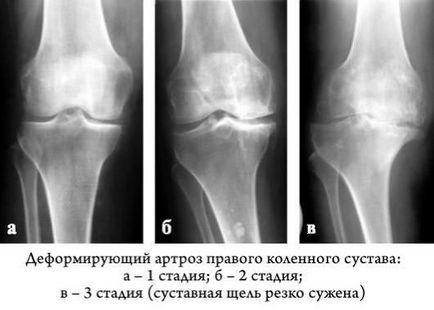 Артроз нижніх кінцівок симптоми і лікування